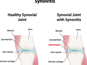 滑膜炎什么膏药管用
