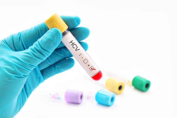 抗乙型肝炎病毒表面抗体大于1000好吗