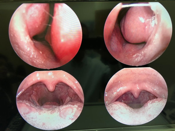 咽部有异物可表现为a痰中带血b咽部有异物感