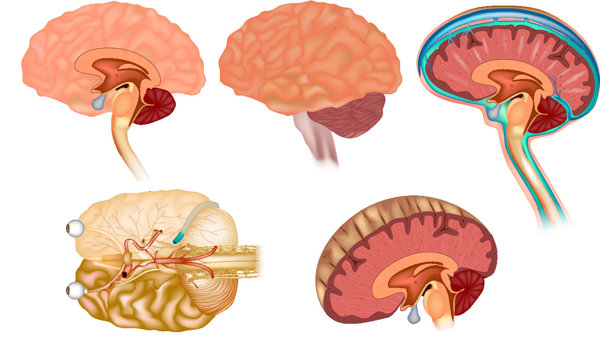 脑垂体腺瘤和脑垂体瘤是一种病吗