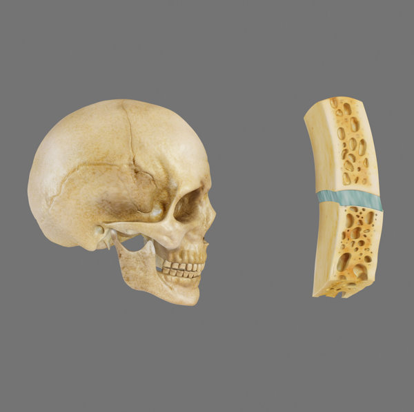颅骨崩裂性骨折和粉碎性骨折区别b